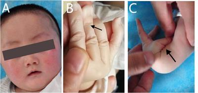 New genetic mutations in a Chinese child with Ehlers-Danlos syndrome-like spondyloepimetaphyseal dysplasia: A case report